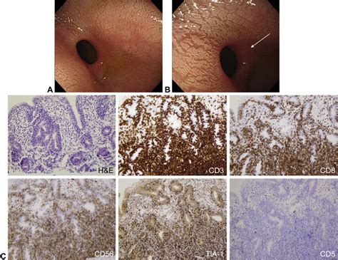 Monomorphic Epitheliotropic Intestinal T Cell Lymphoma Presenting In