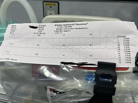 Please help me end this debate! ST Elevation or no ST elevation. : r/EKGs