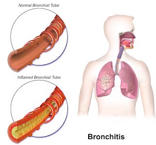 Bronkitis Akut Definisi Penyebab Gejala Pengobatan Dan Pencegahan