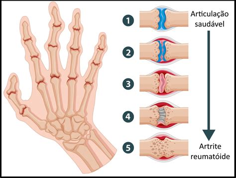 Finalmente Um Tratamento Eficaz Para A Artrite Reumatoide Cientistas