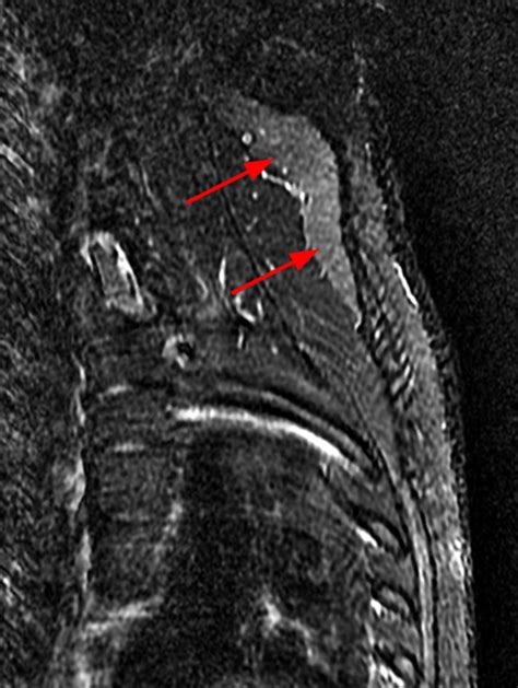 Scapular Winging Radsource