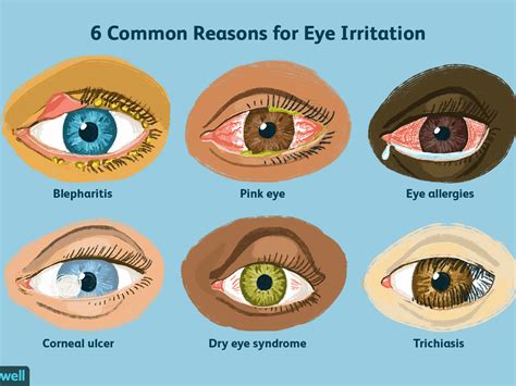 How To Cure Dry Eyes Permanently Medium