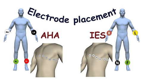 Electrode Placement For Electrical Stimulation Chart