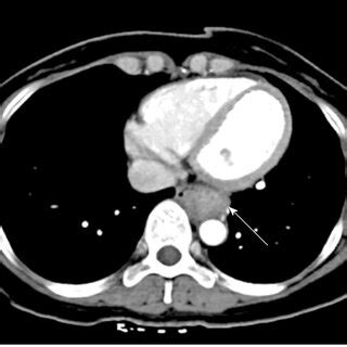 Thoracic Contrast Enhanced Computed Tomography An Enhancing Mass