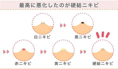 しこりニキビについて ヒロミビューティークリニック