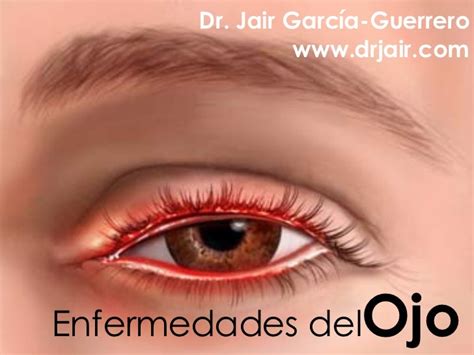 Clase Enfermedades Del Ojo