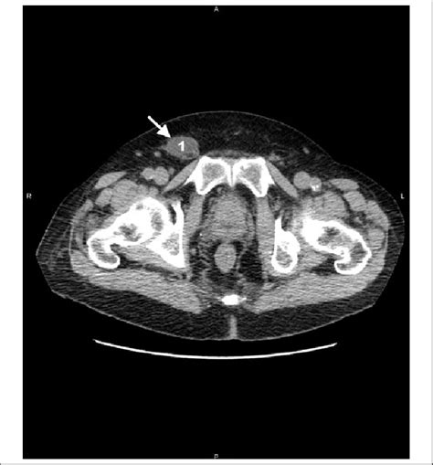 Abdominal Computed Tomography In Axial View Demonstrating A Dilated