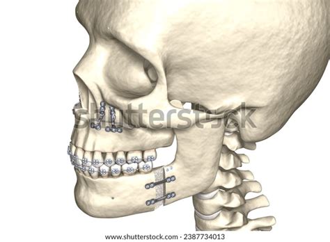 Mandibular Advancement Surgery Medically Accurate Dental Stock