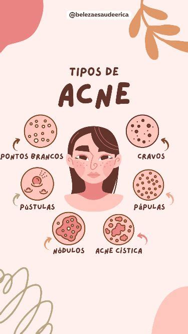 Desvendando os Tipos de Acne Conheça e Previna se para Obter uma Pele