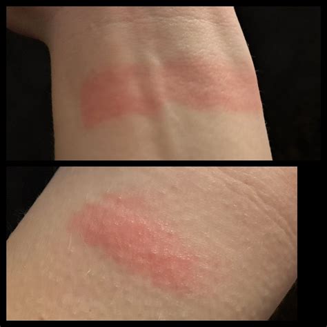 Contact Dermatitis From Mi Band 6 Tips On Hypoallergenic Straps R Miband