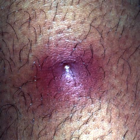 When to Worry About a Lump Under the Skin: 12 Causes