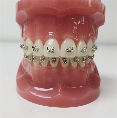 priser goeteborg estetisk tandreglering vasaortodonticom vasa