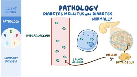 Diabetes Mellitus Dm Nursing Process Adpie Osmosis Video Library