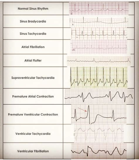 Printable Ekg Cheat Sheet