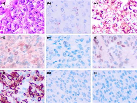 Figure 1 From Vaginal Metastasis From Breast Cancer A Case Report