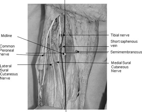 Figure 1 From Surgical Anatomy Of The Proximal Release Of The