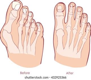 Hallux Valgus Medical Infographic Vector Illustration Stock Vector