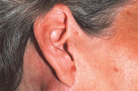 Lymphoma Behind Ear