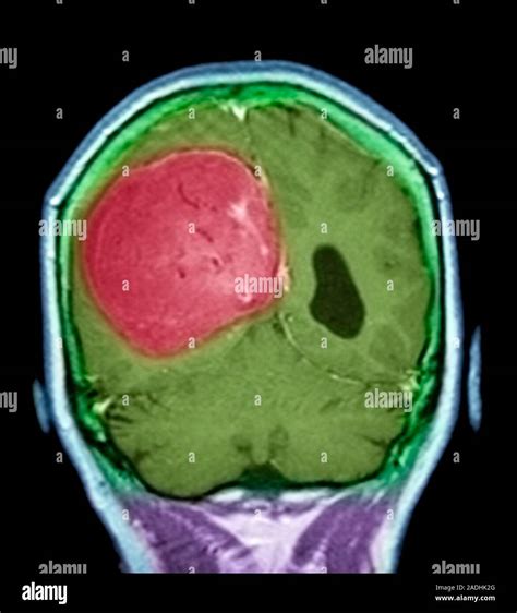 Meningeom Hirntumor Farbige Magnetresonanztomographie Mrt Scan Der