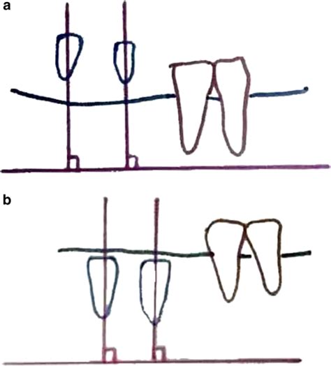 diagnostic  surgical stent  simplified approach  implant