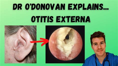 Otitis Externa