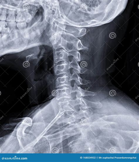 X-ray C-spine or X-ray Image of Cervical Spine Oblique View Stock Photo