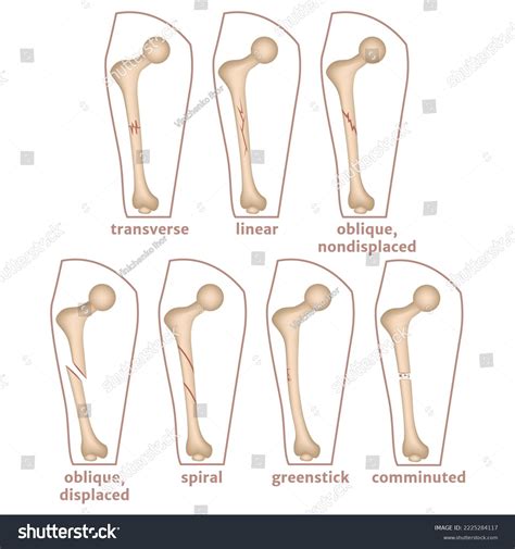 Infographic Types Fractures Human Femur Medical Stock Vector (Royalty