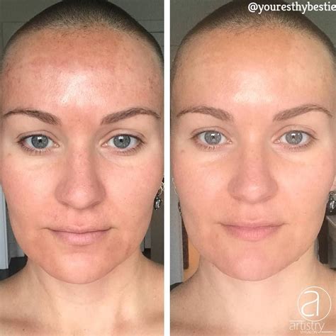 Microneedling Results Left Side Is Less Than 24 Hours After Procedure