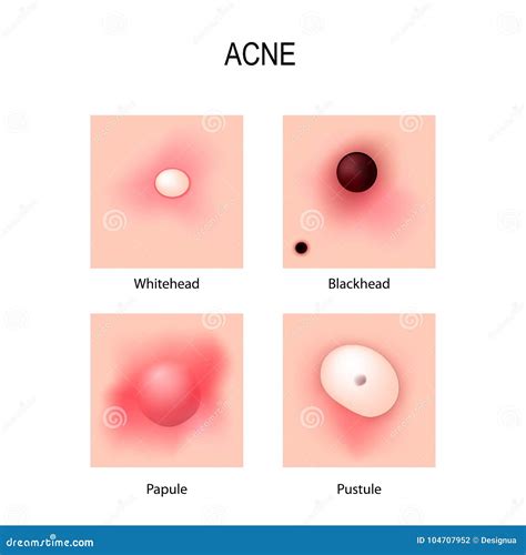 Acne Vulgaris. Stages of Development. Types of Pimples Stock Vector