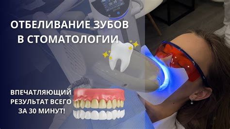 ОТБЕЛИВАНИЕ ЗУБОВ В СТОМАТОЛОГИИ. - YouTube