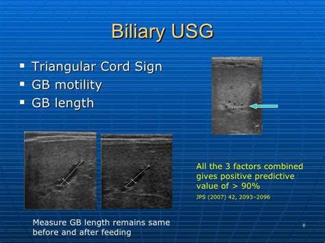 Biliary Atresia