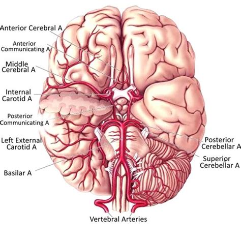 Stroke Lecture Flashcards Quizlet