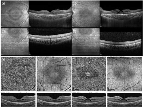 Optical Coherence Tomography Oct And Oct Angiography Images Ab