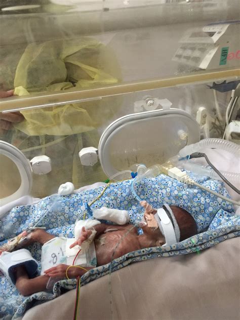 Kangaroo care helped Dubai's 450gm 'miracle' baby survive - News