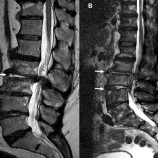 MRI STIR sagittal sequence: SL PSD (A) and adjacent ML PSD (B ...