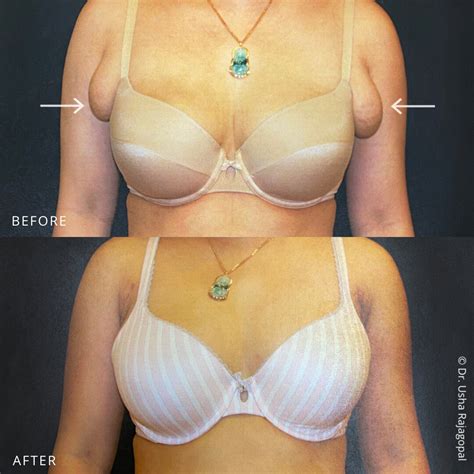 Armpit Liposuction Before And After