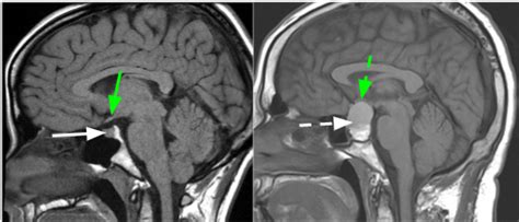 Pituitary Gland Brain