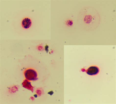 Cryptococcus Neoformans Gram Stain