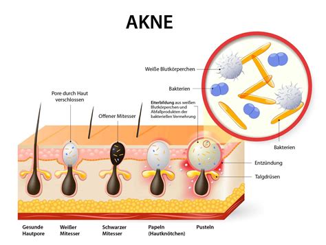 Akne » Formen, Ursachen, Behandlungsmethoden