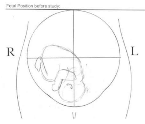6. Baby in vertex position as recorded by the ultrasound measurement ...