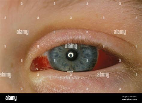 Bleeding In Eye In A Case Of Whooping Cough This Haemorrhaging