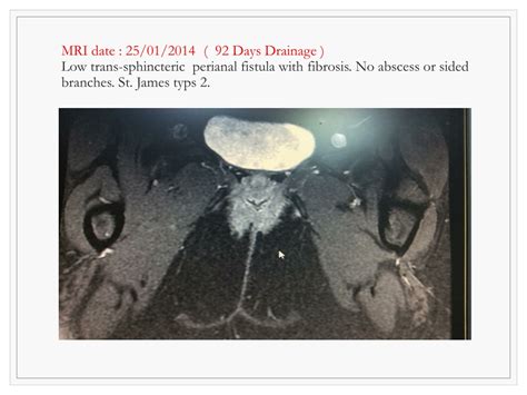 PPT SETON SURGICAL Traetement For Peri Anal Fistula What Causes An