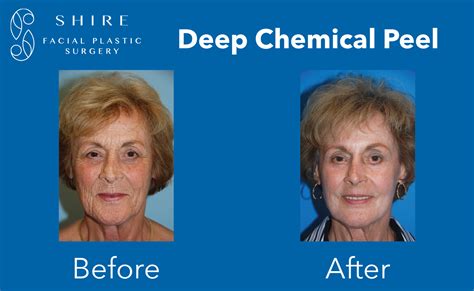 Peels Before After Group Shire Facial Plastic Surgery