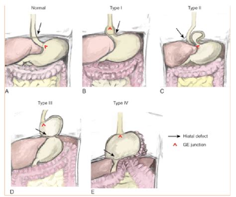 Anatomy Of The Esophagus Gastroesophageal Anatomy Of The Esophagus