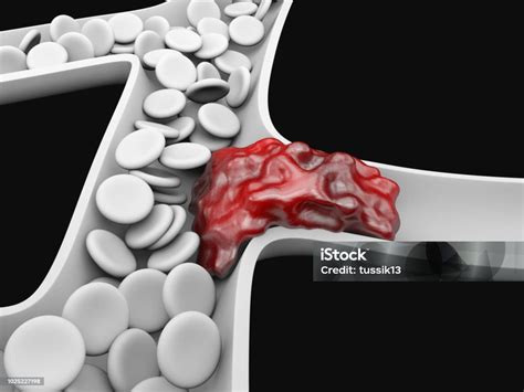 深靜脈血栓或血塊栓塞 照片檔及更多 人體構造 照片 人體構造 健保和醫療 動脈 血管 Istock