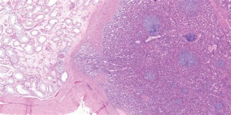 Pathologic Specimen Demonstrating A Benign Splenic Tissue Separated Download Scientific