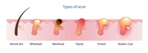 Types of acne vector isolated on white background. Formation of normal ...