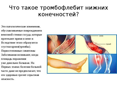 ЛФК при тромбофлебите нижних конечностей