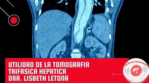 Utilidad De La Tomografia Trifasica En La Evaluaci N Hep Tica Dra