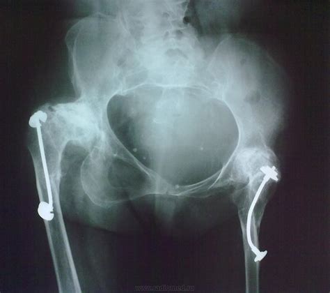 Полиомиелит | Портал радиологов